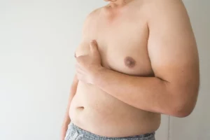 How to Know if You Have Gynecomastia? Banner